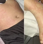 Menina de 10 anos luta contra infecção após contato com detergente Ypê