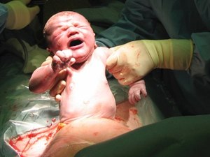 Quantidade de cesáreas cai pela primeira vez no Brasil desde 2010
