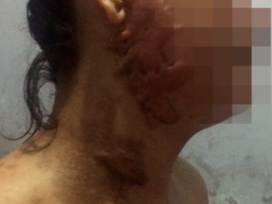 Mulher é atacada no rosto com ácido sulfúrico e ex-namorado é principal suspeito