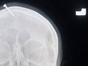 Paquistanesa grávida tem prego martelado na cabeça para dar à luz um menino