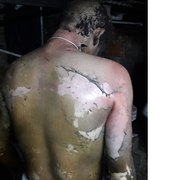 Homem tem corpo parcialmente queimado após jovem jogar gasolina e atear fogo