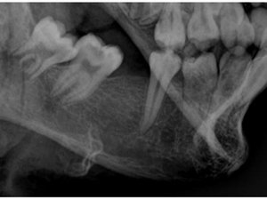 IML identifica corpo encontrado queimado em Arapiraca