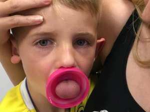Menino de 6 anos passa por cirurgia após ficar com a língua presa em garrafa
