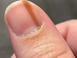 Mulher descobre câncer na unha após viver por anos com mancha incomum