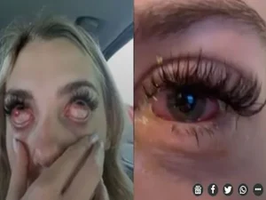 Jovem quase fica cega após fazer extensão de cílios: “Olhos de zumbi”