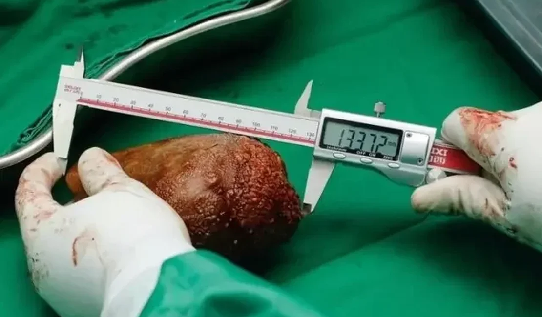 Maior pedra nos rins do mundo é registrada no Guinness Book com 13,37 cm