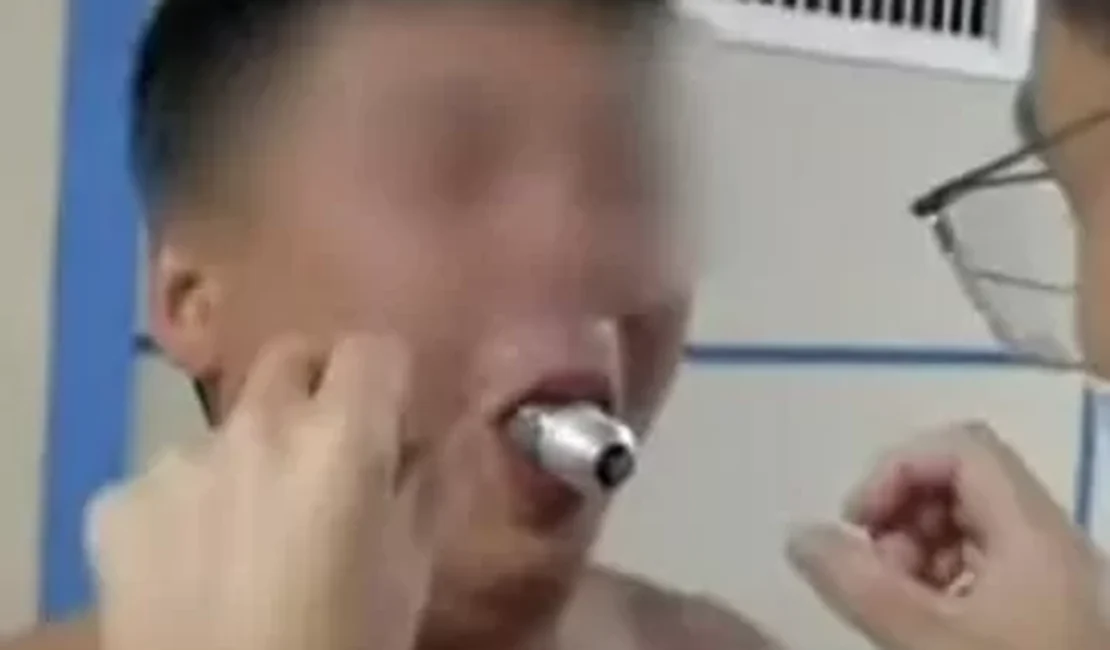 Homem prende lâmpada na boca por desafio e vai parar no hospital na China