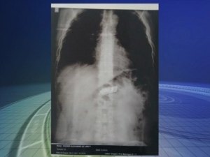 Preso passa por cirurgia para retirada de celular do estômago