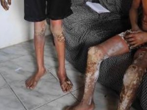 Menor que teve o corpo queimado por fogos de artificio é transferido para o HGE