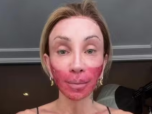 Com o rosto vermelho após novo peeling, Maya Massafera rebate críticas