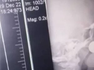 Espirro salva menino que estava com moeda no nariz de passar por cirurgia