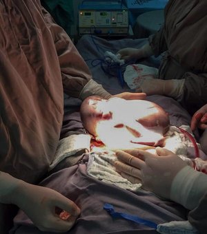 Bebê nasce dentro da bolsa amniótica durante parto raríssimo em SP
