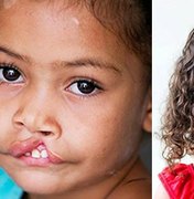 ONG fará 40 cirurgias de correção de lábio leporino em Maceió