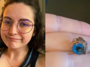 Jovem descobre que tinha miçanga 'perdida' dentro do nariz há 20 anos