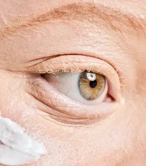 Pessoas com albinismo terão acesso gratuito a protetor solar em Maceió