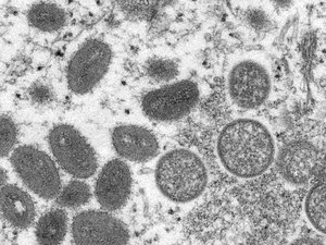 Brasil investiga dois casos suspeitos da varíola do macaco