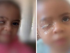 Menina de 2 anos vai parar no hospital após grudar olho com cola, no DF