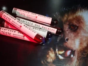 Ministério da Saúde confirma 9º caso de varíola dos macacos no Brasil