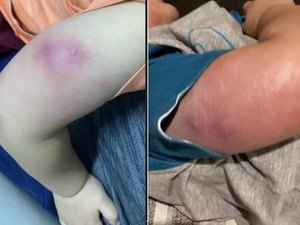 Criança é hospitalizada com infecção grave após vacinação em posto de saúde de Maceió