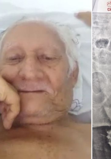 Idoso aguarda há quase 50 dias por cirurgia no colo do fêmur, em Arapiraca, e família aciona a justiça