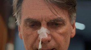 Bolsonaro tem dreno retirado, não tem febre e segue com boa evolução clínica, diz boletim
