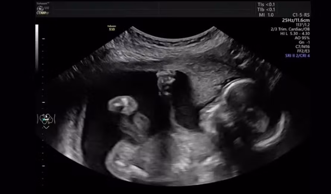 Bebê é vista 'dando soco' na mãe durante exame de ultrassom: 'Personalidade forte'