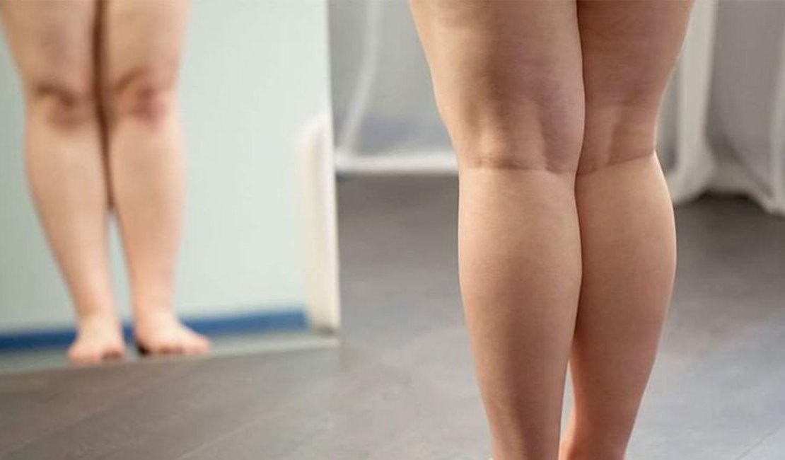 Lipedema: Muito Além da 'celulite'; entenda a condição