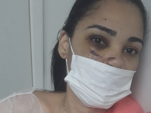 Arapiraquense demitida após queda de moto faz rifa para recuperar dentes que quebraram no acidente