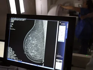Ministério da Saúde passa a recomendar mamografia a partir dos 40 anos
