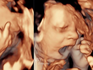 Bebê choca pais ao mostrar 'dedo do meio' e bocejar em ultrassom