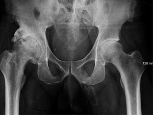 Após queda, homem descobre que seu pênis está se transformando em osso