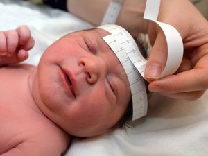 Ministério da saúde confirma 77 casos de microcefalia em AL