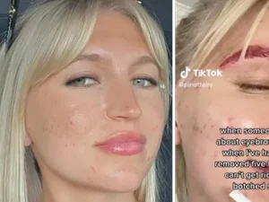 TikToker tenta remover tatuagem na sobrancelha e resultado choca web