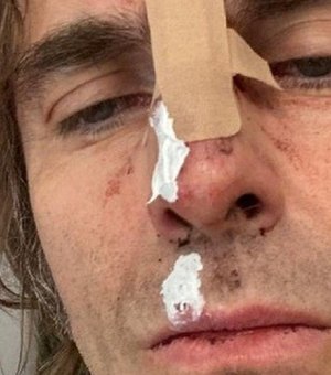 Liam Gallagher mostra rosto machucado depois de cair de helicóptero após show
