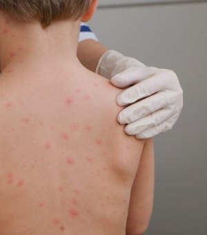 Alagoas lidera incidência de meningite no Nordeste e ocupa segunda posição no país