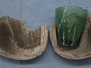 Médicos acham copo na bexiga de paciente, anos após 'brincadeira sexual'