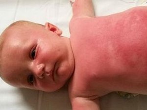 Bebê de 3 meses é internado após usar filtro solar da Peppa Pig