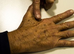 Tecnologia para tratar câncer de pele é aprovado para uso no SUS
