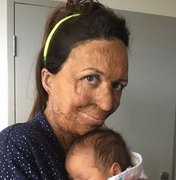 Ex-modelo que teve 60% do corpo queimado dá à luz primeiro filho
