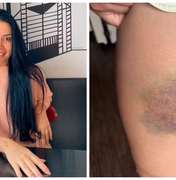 Nutricionista lutou por 13 minutos contra agressor que invadiu sua casa para estuprá-la: 'Briguei pela vida'