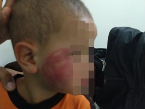Padastro usa sandália de couro para espancar criança e deixa marcas na face 
