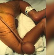 Criança prematura nasce com cauda de 12 centímetros e uma bola na ponta em caso 'raríssimo'