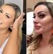 Andressa Urach faz preenchimento no nariz e no queixo: 'Fiquei com cara de rica'