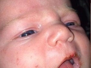 Bebê quase morre após contrair herpes labial