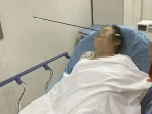 Mulher tem rosto atravessado por flecha de aço de 70 cm na China