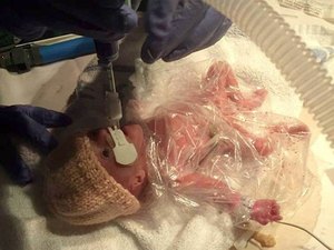 Bebê prematura e com 560 gramas é salva por saco plástico de sanduíche