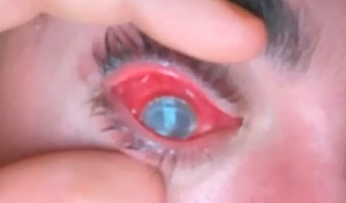 Homem tem olho devorado por parasita após dormir com lentes de contato