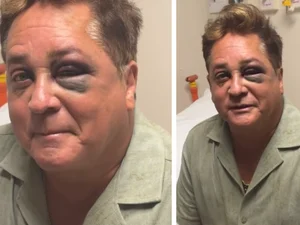 Leonardo aparece com olho roxo após sofrer acidente em pescaria; veja