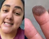 Mulher precisa depilar dedo após fazer enxerto com pele da virilha