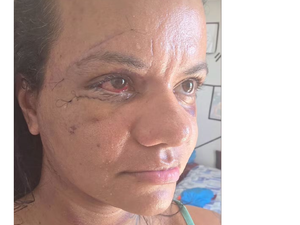 Mulher espancada com mais de 60 socos mostra rosto após cirurgia para reconstrução facial